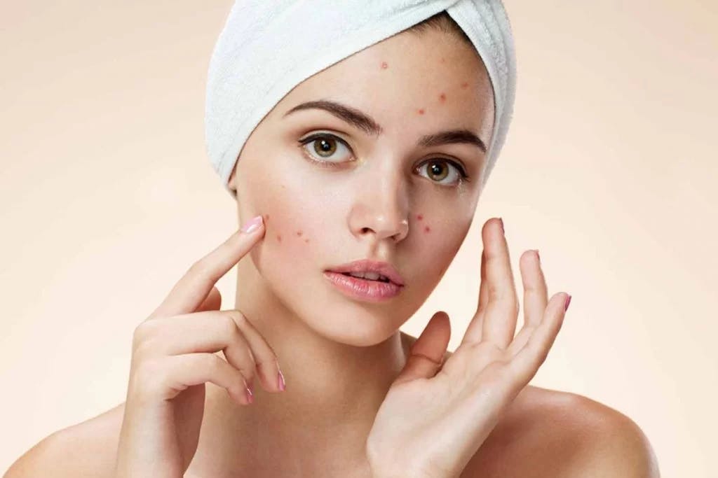 Acne-Home-Treatments-That-Dermatologists-Say-Work-1024x683