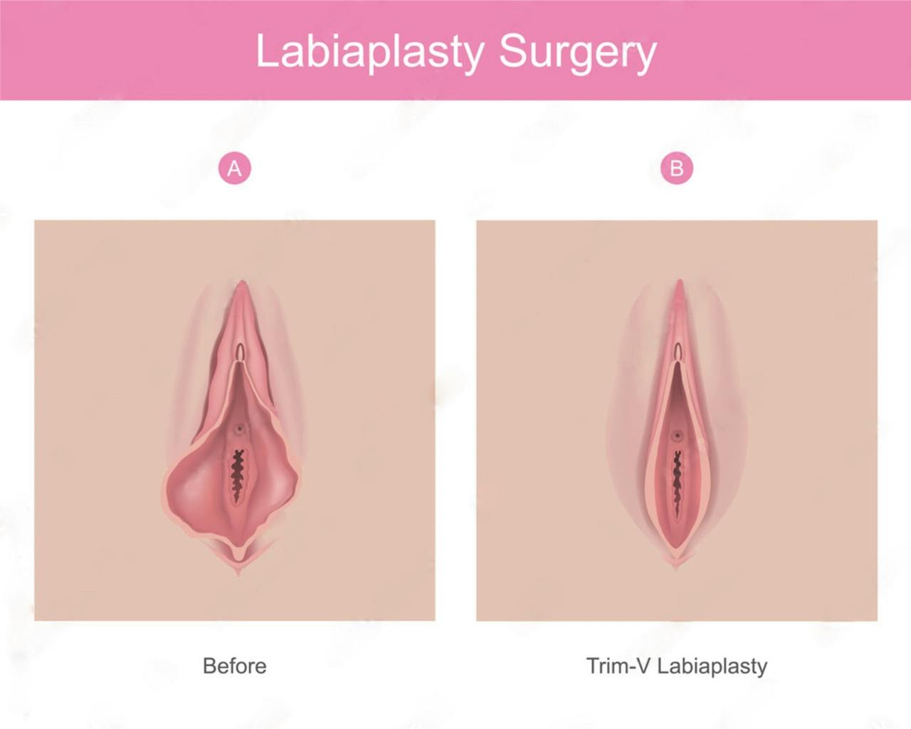 جراحی لابیاپلاستی